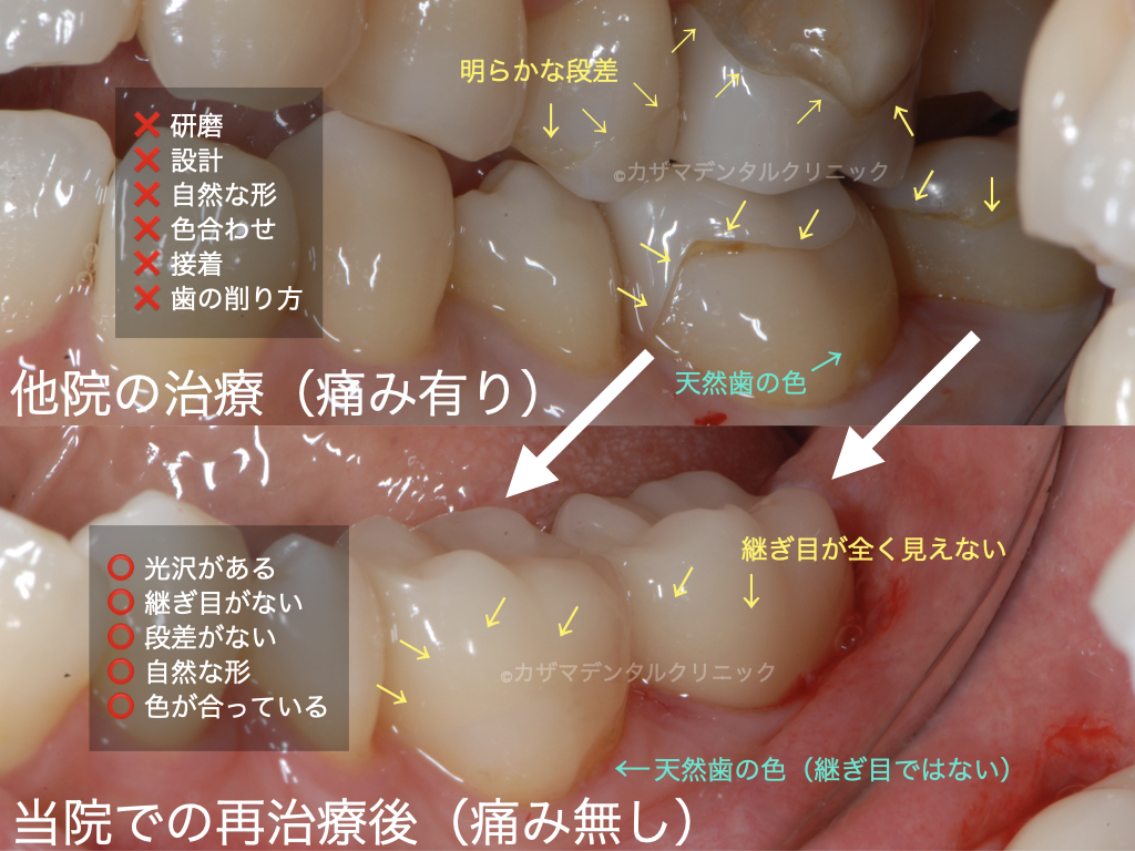 【誰にでも分かる正しいセラミック治療の見分け方:良くない奥歯のセラミック治療のやりなおし事例】下段がカザマデンタルクリニックでの治療。上段が他院での治療。非常に大きな段差さ隙間があり、歯と色が合っていない。また作られたセラミックの形も不自然で、天然歯の削り方もセラミックに適切でない。