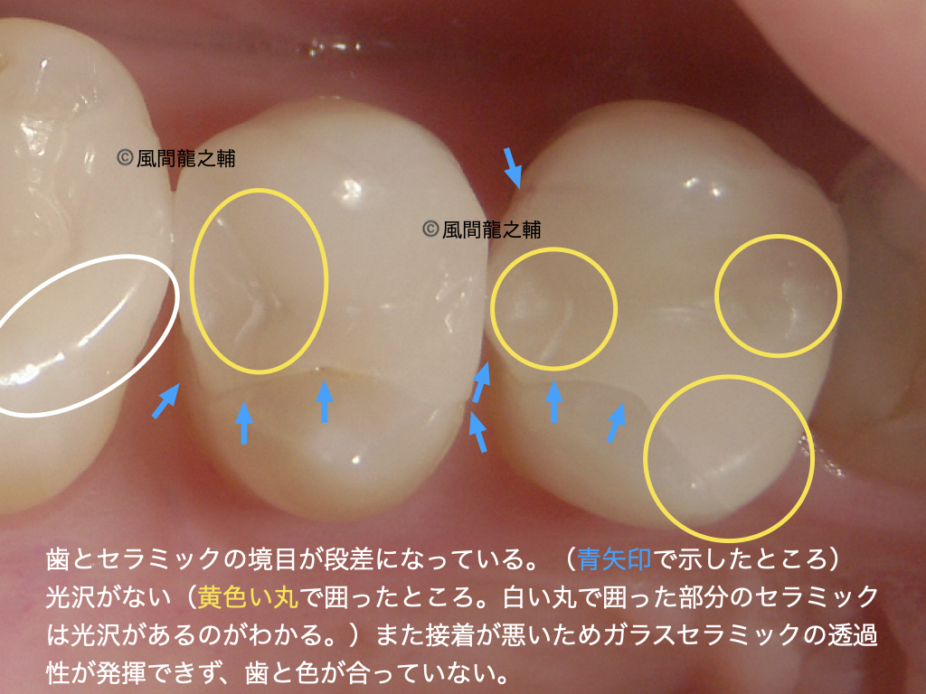 誰でも分かる「良くないセラミック治療」例:段差があるのは様々なトラブルの元になる。光沢がないのは研磨が足りていないから。研磨を十分にしないと、目に見えないヒビを除去できていなかったり、噛み合わせで抵抗が強くなる、歯の色がなじまないなど様々な問題の原因になる。