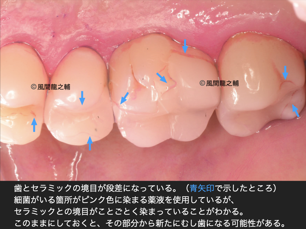 誰でも分かる「良くないセラミック治療」例:段差・境界に虫歯