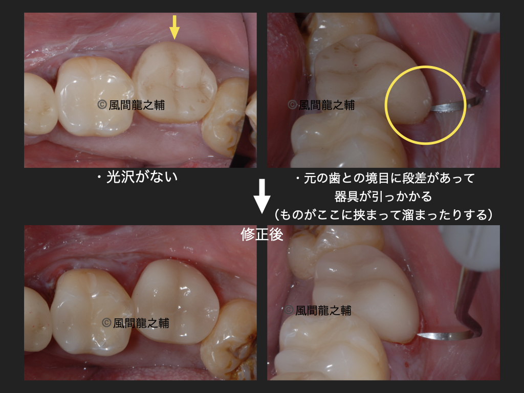 誰でも分かる「良くないセラミック治療」例:段差の下にフックが隠れているのに注目。