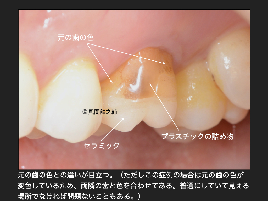 誰でも分かる「良くないセラミック治療」例:色の違い