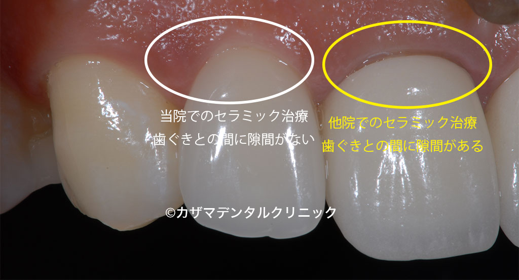 誰でも分かる「良くないセラミック治療」例:歯ぐきとセラミック歯の間に隙間があるとそこから虫歯になりやすい。早期の再治療をお勧めします。