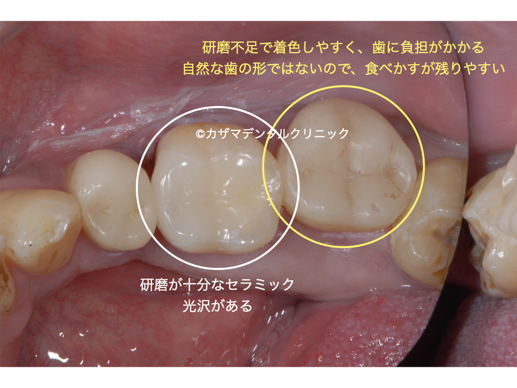 誰でも分かる「良くないセラミック治療」例:研磨不足。光沢がない。どの材料を用いるかにかかわらず、研磨はとても重要です。研磨は日本の歯科治療に於いてもっとも軽視されています。